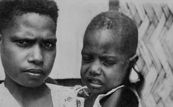 New Guinea child suffering from the disease, yaws, after two or three injections.