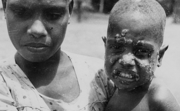 New Guinea child with the yaws.