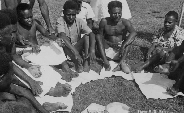 Lepers showing crippled hands and feet at Mt. Hagen Station, Papua New Guinea